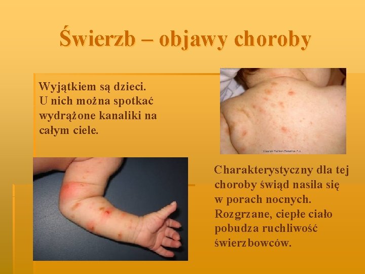 Świerzb – objawy choroby Wyjątkiem są dzieci. U nich można spotkać wydrążone kanaliki na