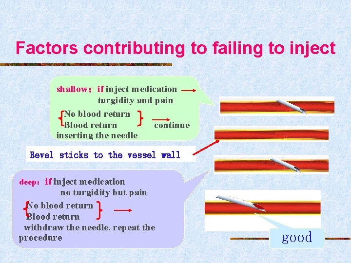 Factors contributing to failing to inject shallow：if inject medication turgidity and pain No blood