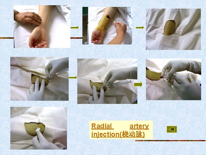 Radial artery injection(桡动脉) 