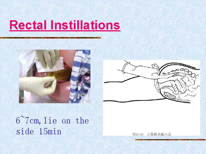 Rectal Instillations 6~7 cm, lie on the side 15 min 