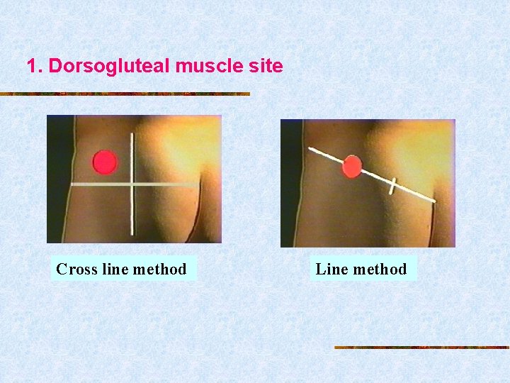 1. Dorsogluteal muscle site Cross line method Line method 