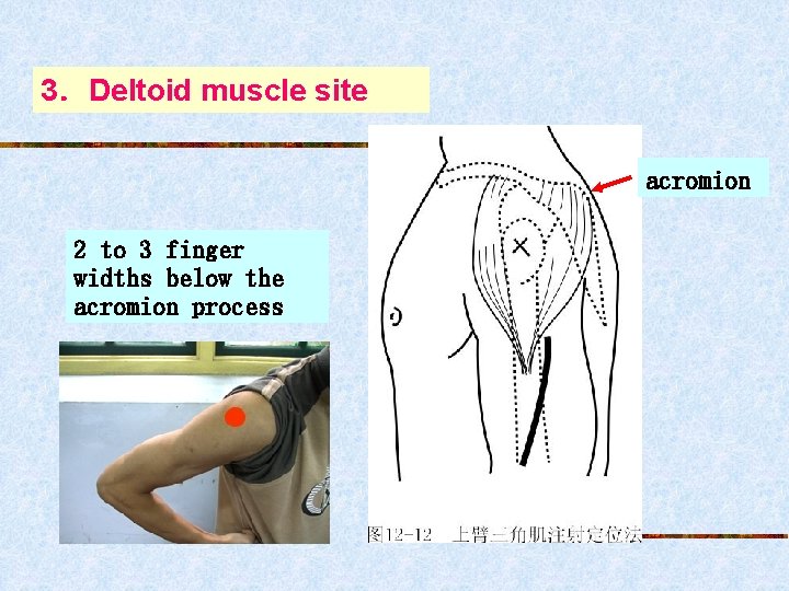 3．Deltoid muscle site acromion 2 to 3 finger widths below the acromion process 