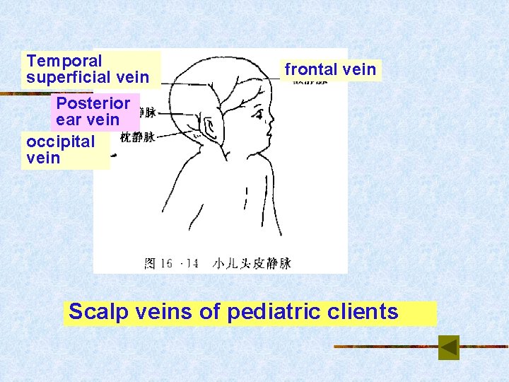Temporal superficial vein frontal vein Posterior ear vein occipital vein Scalp veins of pediatric