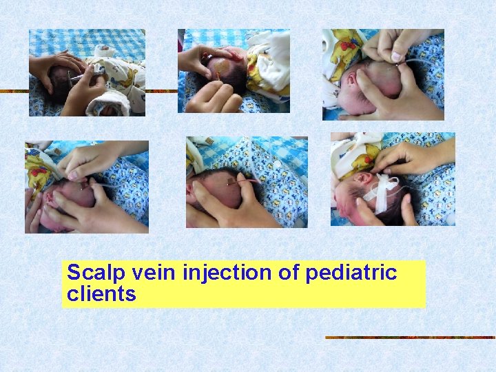 Scalp vein injection of pediatric clients 