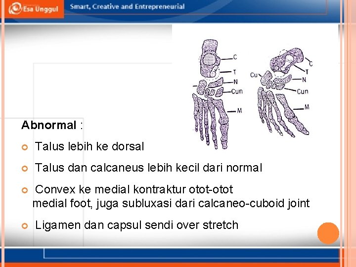 Abnormal : Talus lebih ke dorsal Talus dan calcaneus lebih kecil dari normal Convex