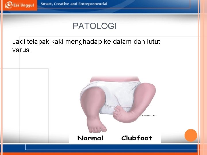 PATOLOGI Jadi telapak kaki menghadap ke dalam dan lutut varus. 