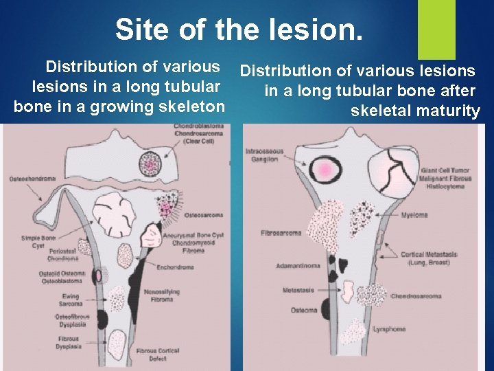 Site of the lesion. Distribution of various lesions in a long tubular bone after