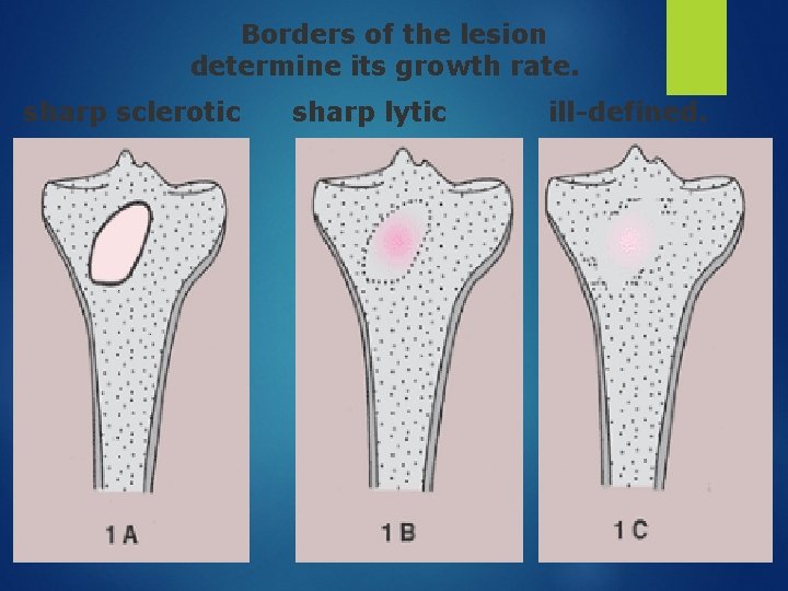 Borders of the lesion determine its growth rate. sharp sclerotic sharp lytic ill-defined. 