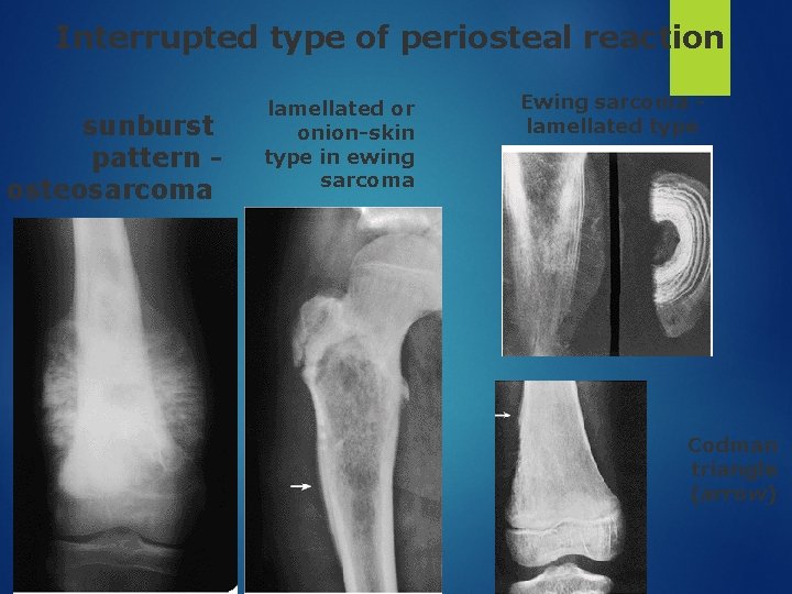 Interrupted type of periosteal reaction sunburst pattern osteosarcoma lamellated or onion-skin type in ewing