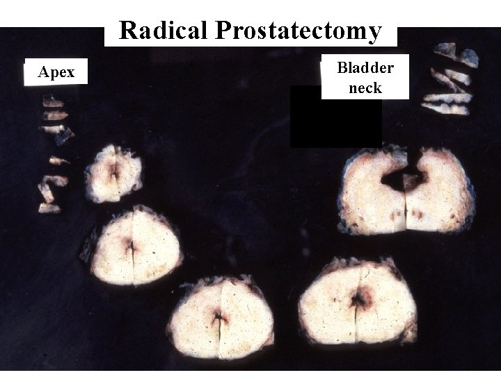 Radical Prostatectomy Apex Bladder neck 