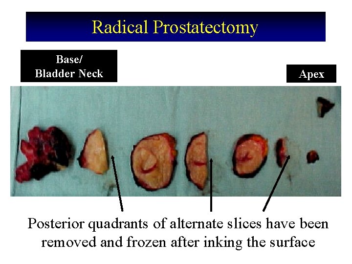 Radical Prostatectomy Base/ Bladder Neck Apex Posterior quadrants of alternate slices have been removed