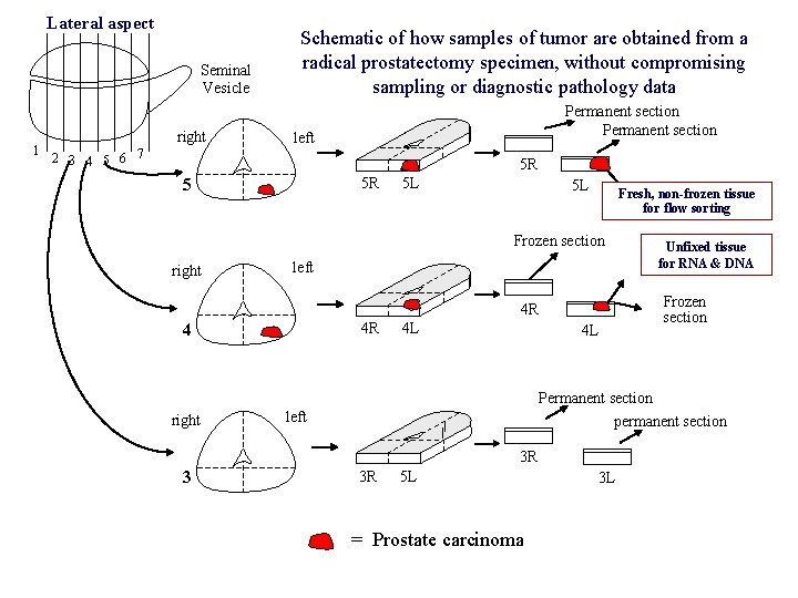 Lateral aspect Seminal Vesicle 1 right Schematic of how samples of tumor are obtained