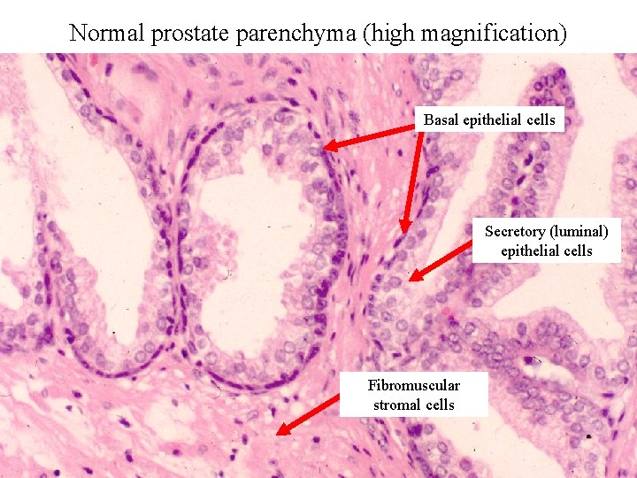Normal prostate parenchyma (high magnification) Basal epithelial cells Secretory (luminal) epithelial cells Fibromuscular stromal