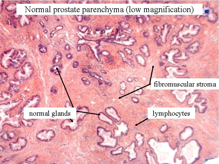 Normal prostate parenchyma (low magnification) fibromuscular stroma normal glands lymphocytes 