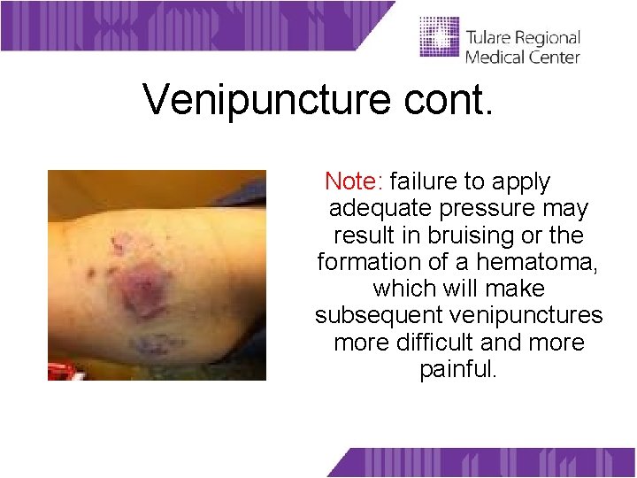 Venipuncture cont. Note: failure to apply adequate pressure may result in bruising or the