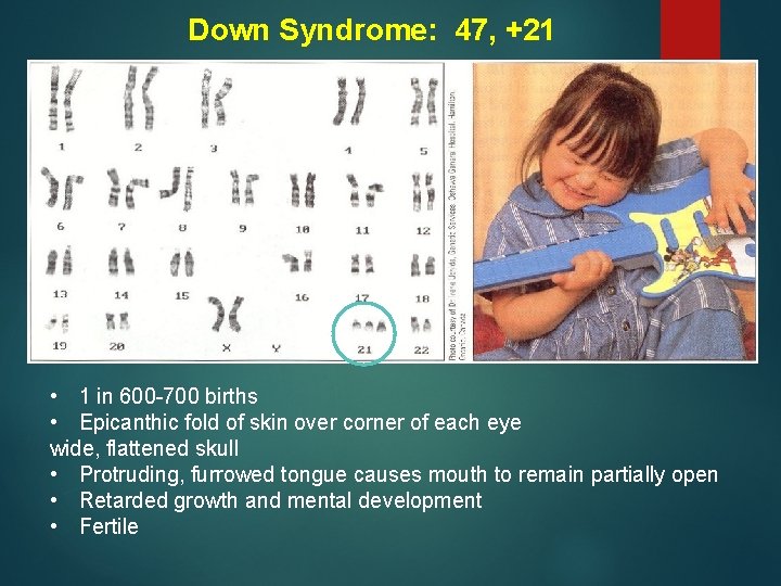 Down Syndrome: 47, +21 • 1 in 600 -700 births • Epicanthic fold of