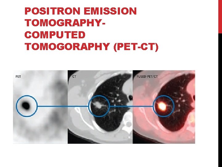 POSITRON EMISSION TOMOGRAPHYCOMPUTED TOMOGORAPHY (PET-CT) 
