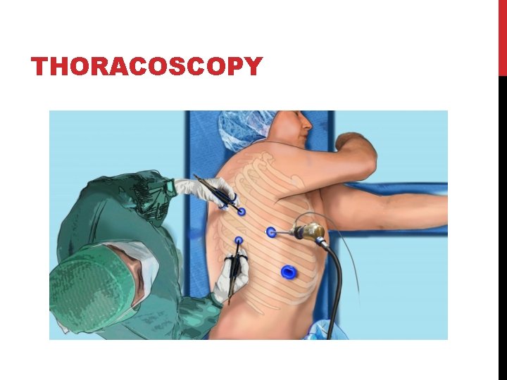 THORACOSCOPY 