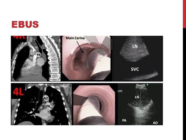 EBUS 