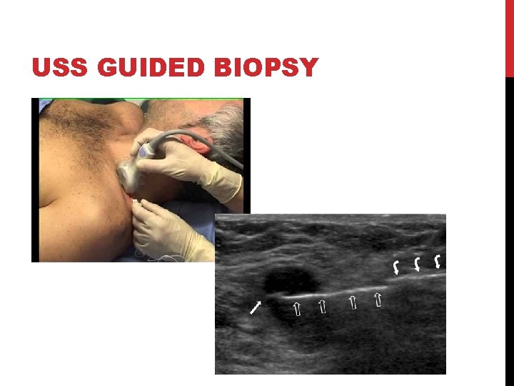 USS GUIDED BIOPSY 