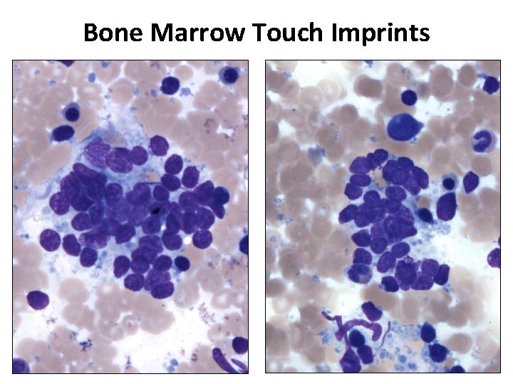 Bone Marrow Touch Imprints 