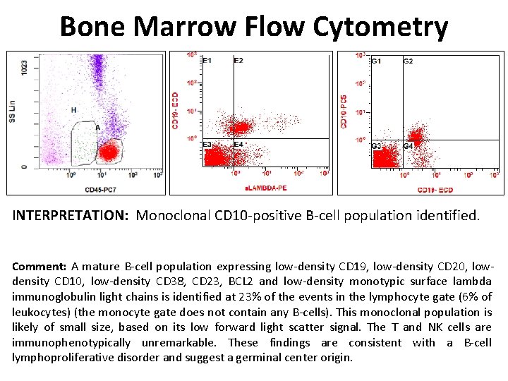 Bone Marrow Flow Cytometry INTERPRETATION: Monoclonal CD 10 -positive B-cell population identified. Comment: A