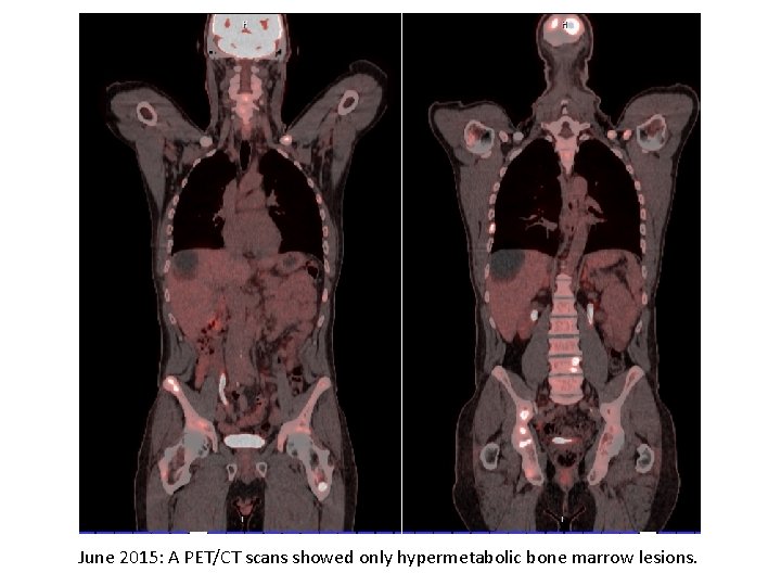 June 2015: A PET/CT scans showed only hypermetabolic bone marrow lesions. 