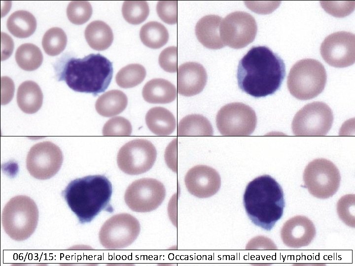 06/03/15: Peripheral blood smear: Occasional small cleaved lymphoid cells 