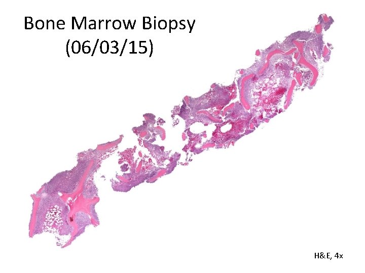 Bone Marrow Biopsy (06/03/15) H&E, 4 x 