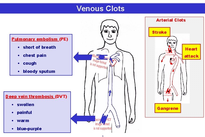 Venous Clots Arterial Clots Stroke Pulmonary embolism (PE) • short of breath Heart •