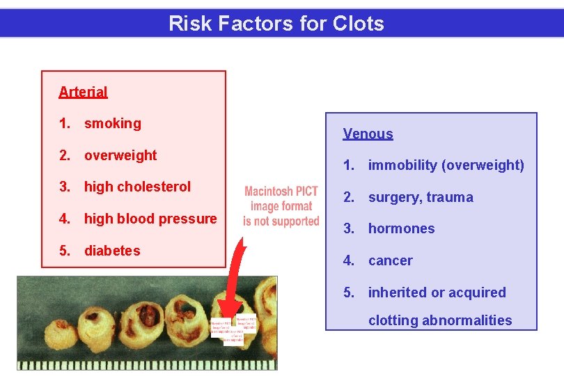 Risk Factors for Clots Arterial 1. smoking 2. overweight 3. high cholesterol 4. high