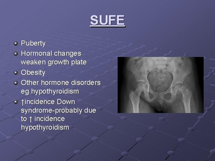 SUFE Puberty Hormonal changes weaken growth plate Obesity Other hormone disorders eg hypothyroidism ↑incidence