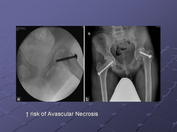↑ risk of Avascular Necrosis 