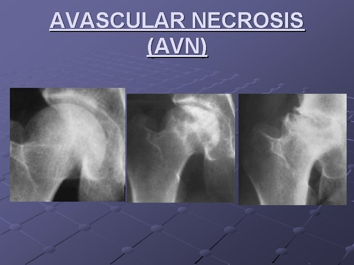 AVASCULAR NECROSIS (AVN) 