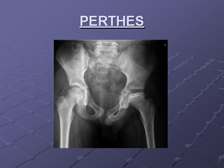 PERTHES 