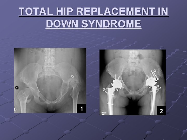 TOTAL HIP REPLACEMENT IN DOWN SYNDROME 