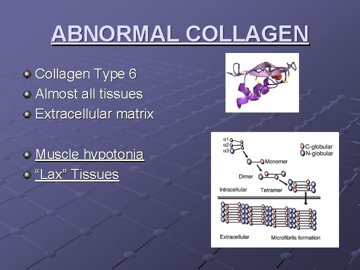 ABNORMAL COLLAGEN Collagen Type 6 Almost all tissues Extracellular matrix Muscle hypotonia “Lax” Tissues