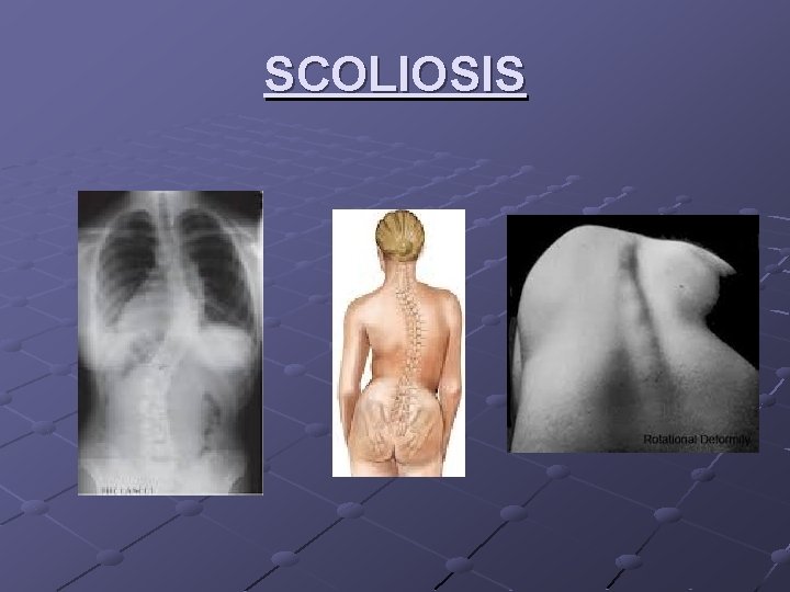 SCOLIOSIS 