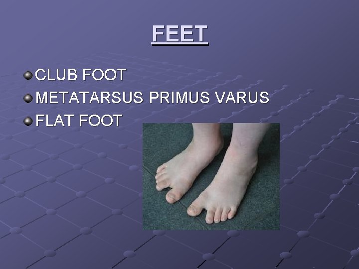 FEET CLUB FOOT METATARSUS PRIMUS VARUS FLAT FOOT 