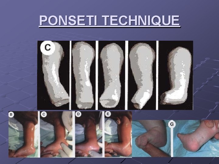 PONSETI TECHNIQUE 