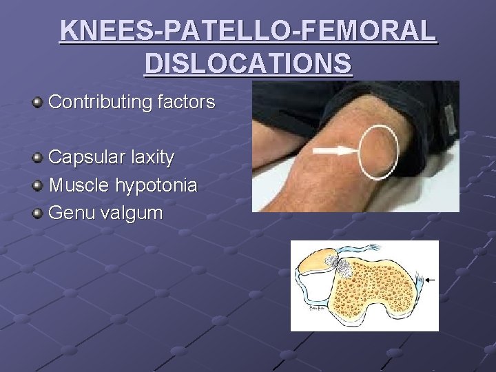 KNEES-PATELLO-FEMORAL DISLOCATIONS Contributing factors Capsular laxity Muscle hypotonia Genu valgum 