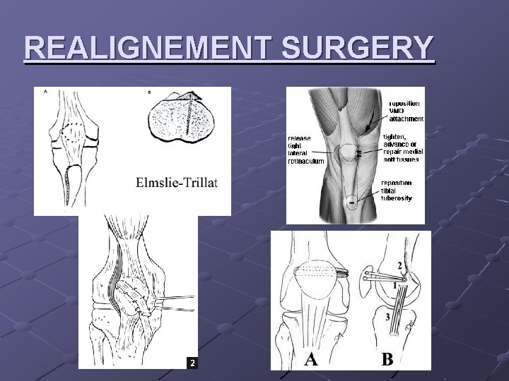 REALIGNEMENT SURGERY 