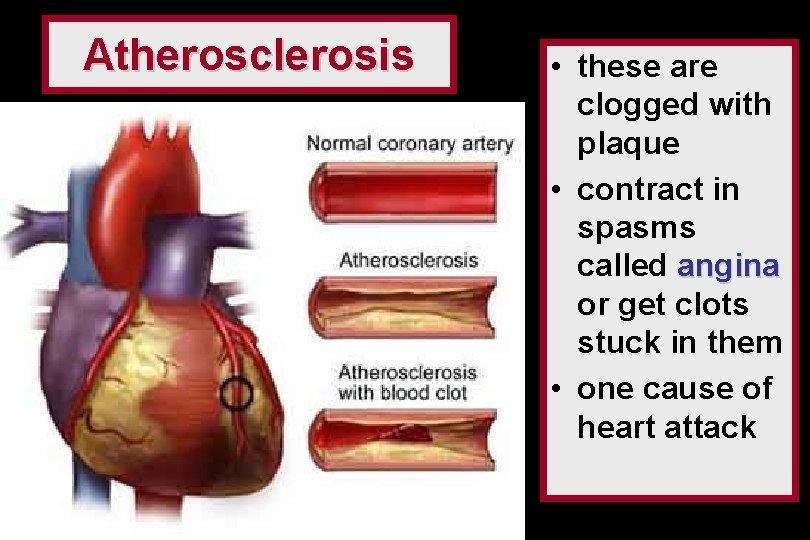 Atherosclerosis • these are clogged with plaque • contract in spasms called angina or