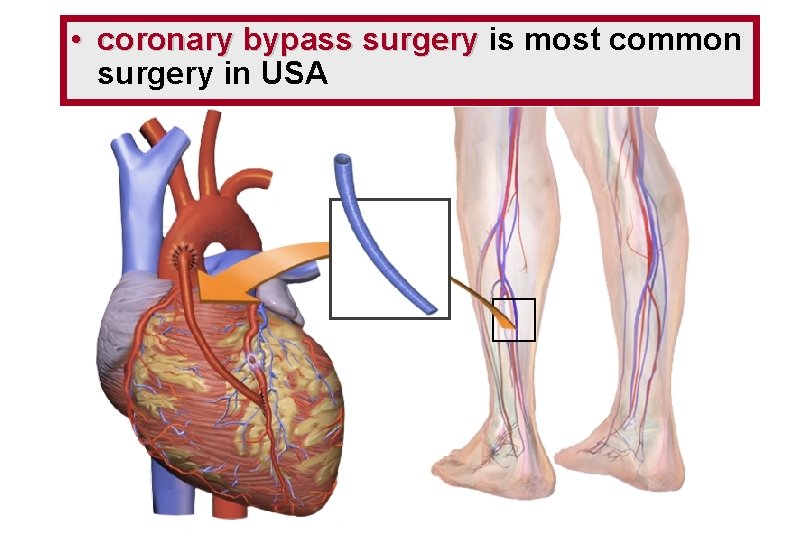  • coronary bypass surgery is most common surgery in USA 