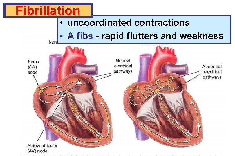 Fibrillation • uncoordinated contractions • A fibs - rapid flutters and weakness 