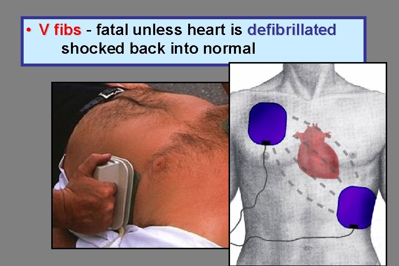  • V fibs - fatal unless heart is defibrillated shocked back into normal