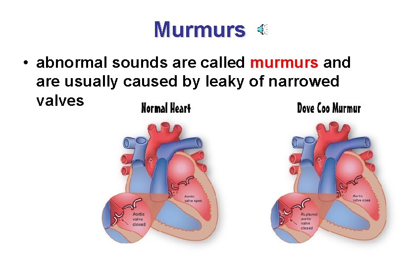 Murmurs • abnormal sounds are called murmurs and are usually caused by leaky of
