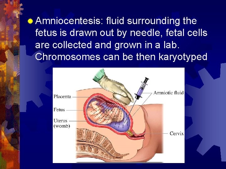 ® Amniocentesis: fluid surrounding the fetus is drawn out by needle, fetal cells are