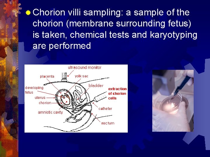 ® Chorion villi sampling: a sample of the chorion (membrane surrounding fetus) is taken,