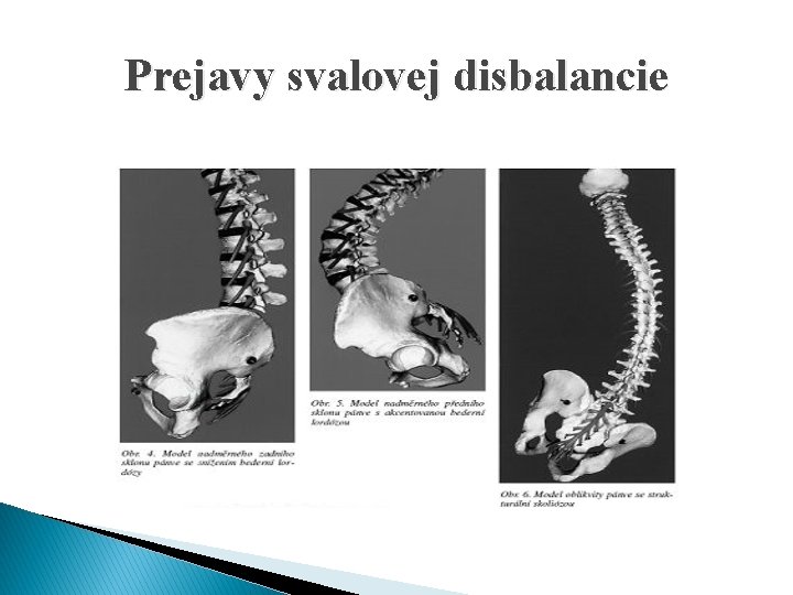 Prejavy svalovej disbalancie 